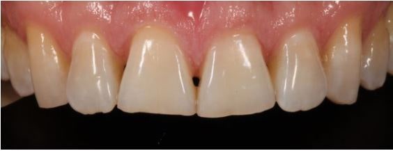 Figure 1: Preoperative view of maxillary central incisors showing incisal wear after orthodontic repositioning. 