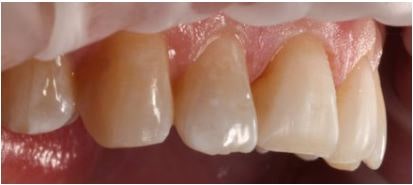 Figure 2: Tooth preparation withfacio-incisal bevel and air abrasion.