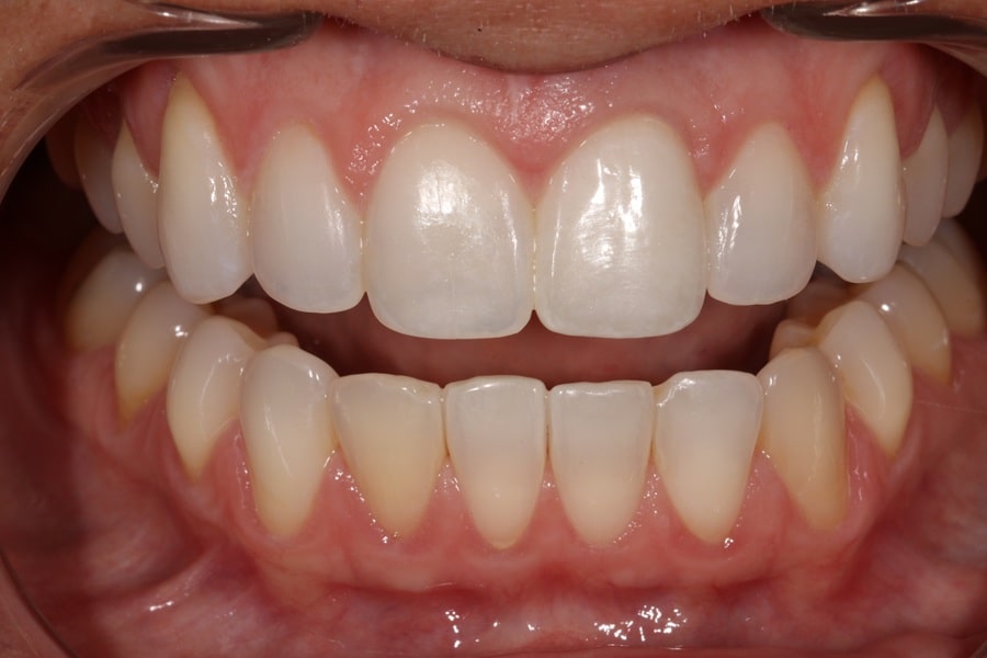 AACD Journal of Cosmetic Dentistry Multidisciplinary Approach to Achieve Excellence in an Anterior Implant Case